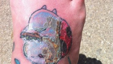Infected Tattoos: Signs, Causes, How to Cure & Everything