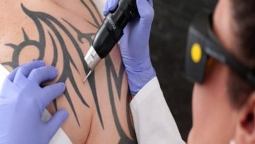 10+ Things You Need to Know About Laser Tattoo Removal