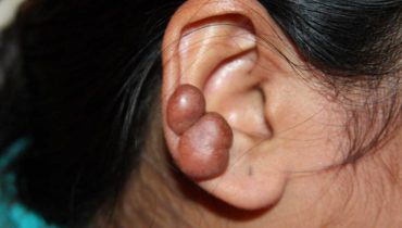 Keloids on Piercings: How to Deal? Removal & Prevention Guide